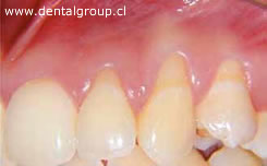 Reseción Gingival caso 1