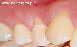 Reseción Gingival caso 2